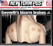 Gwyneth's bizarre bruises